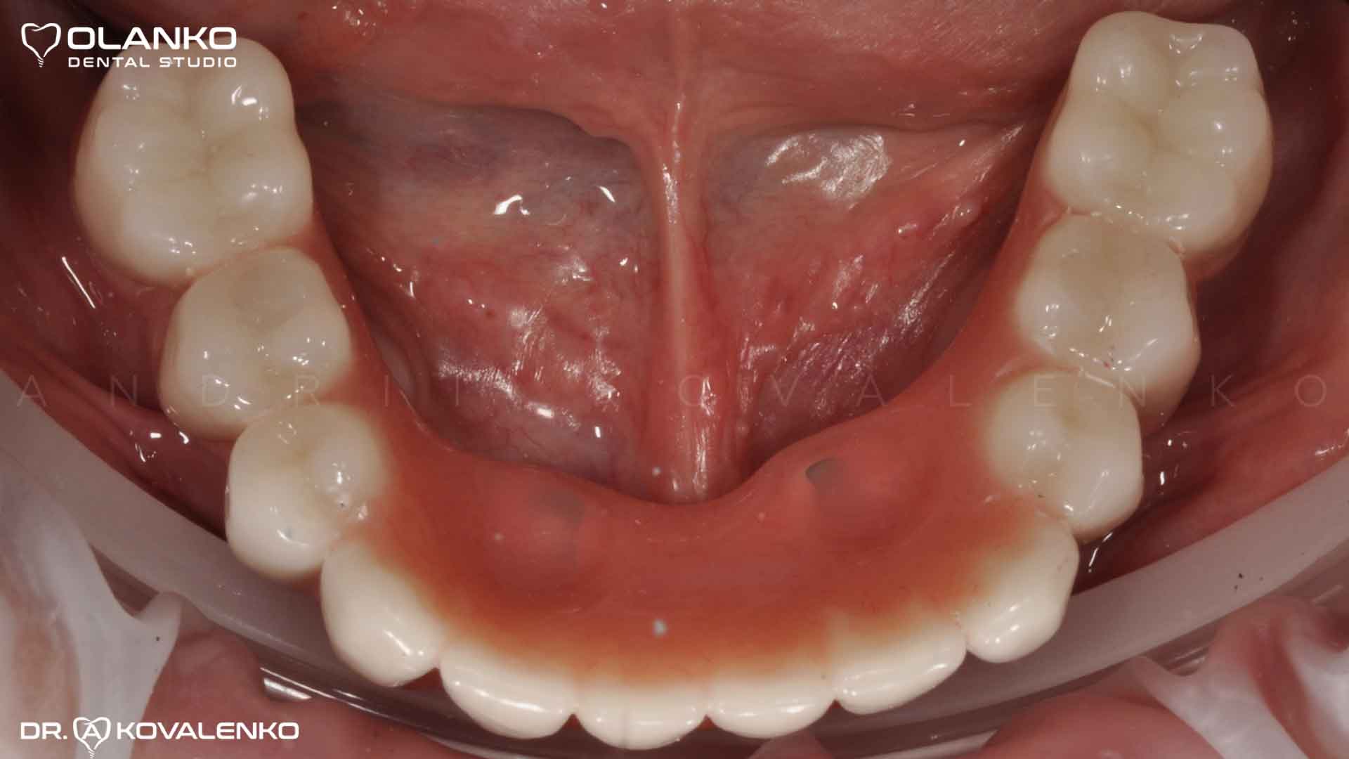 Клинический случай 9 имплантация зубов
